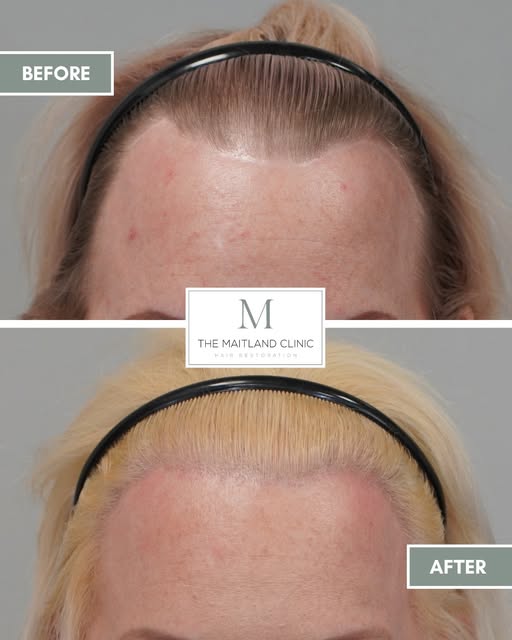 2628 grafts by FUT to lower, thicken and create a softer, more feminine hairline and camouflage exis