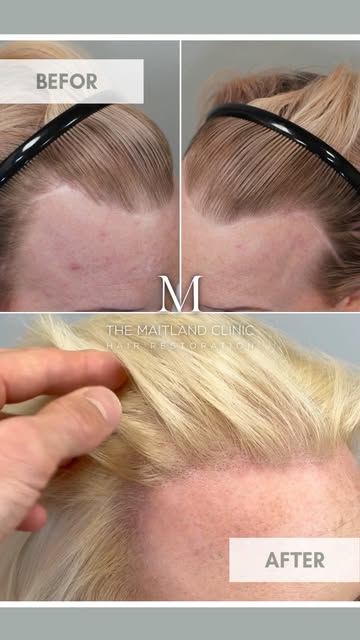 A closer look at the 2628 grafts by FUT results we shared previously.

The aim was to lower and soft