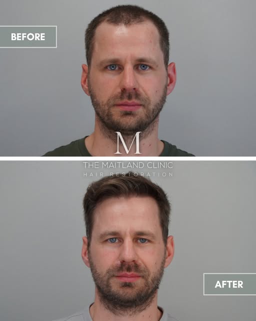 1163 grafts by FUE to restore the frontal hairline and temporal angles.

The aim was to create a nat