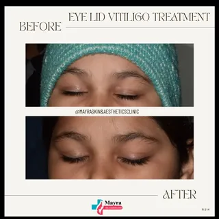 EYE LID VITILIGO TREATMENT 
Before ➡️ After

Vitiligo can be challenging, but with the right care an