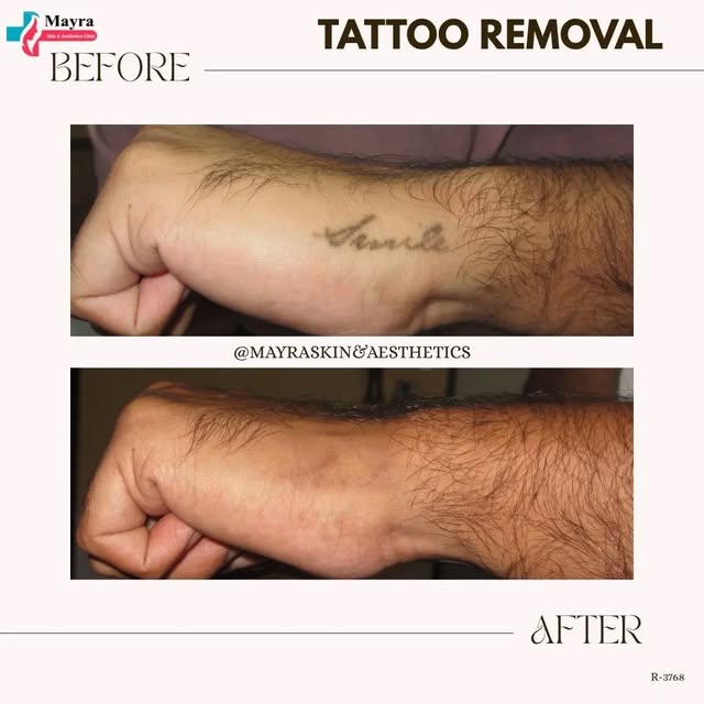 Regret your tattoo? Erase it, don't hide it. ✨
Check this amazing Tattoo Removal transformation at M