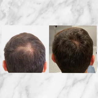 Un de nos patients, après 5 séances de PRP.
#greffedecheveux #prp #greffecapillaire #implantcapillai