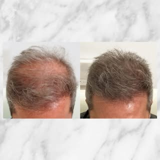 Un de nos patients, après 6 séances de PRP.
#greffedecheveux #prp #greffecapillaire #implantcapillai