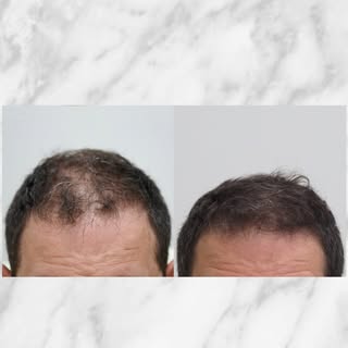 Un de nos patients, après 6 séances de PRP.
#greffedecheveux #prp #greffecapillaire #implantcapillai