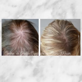 Une de nos patientes, après 5 séances de PRP.
#greffedecheveux #prp #greffecapillaire #implantcapill