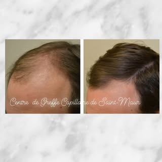 Un de nos patients, après 6 séances de PRP.
#greffedecheveux #prp #greffecapillaire #implantcapillai