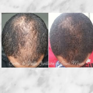Un de nos patients, après 6 séances de PRP.
#greffedecheveux #prp #greffecapillaire #implantcapillai
