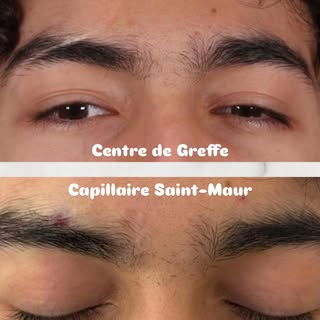 Un de nos patients, 8 mois après la greffe capillaire de sourcils dans notre centre. #greffecapillai