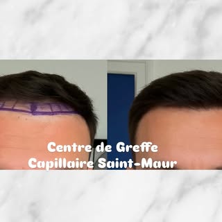 Un de nos patients, 8 mois après la greffe capillaire dans notre centre. #greffecapillaire #implantc
