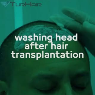 First Hair Washing Video with 🩺| Dr.Demir 
#hairtransplantturkey #hairtransplant #присажданенакоса 