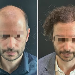 2853 Grafts ( First Session) incredible result❗️
 Contact us for free consultation🤳📧
info@turhair.