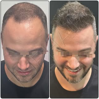 3860 Grafts incredible result❗️
 Contact us for free consultation🤳📧
info@turhair.com
+359887591059