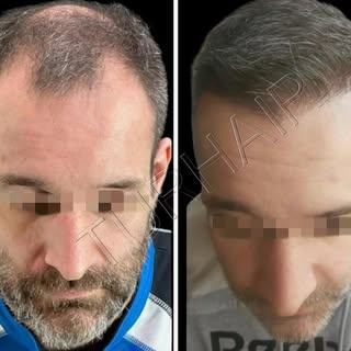 3712 Grafts incredible result❗️
 Contact us for free consultation🤳📧
info@turhair.com
+359887591059