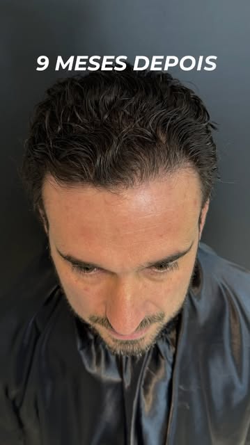 Resultado real: Após o procedimento! 🔍

Muitos homens esperam o "momento certo" para tratar a calví