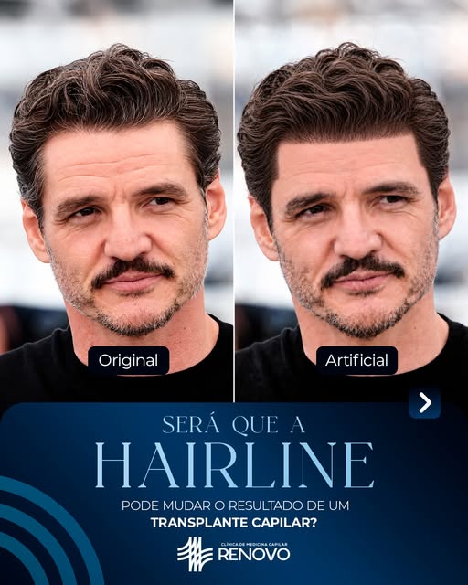 Em um transplante capilar, não basta preencher áreas com menor densidade.

 O desenho da hairline te