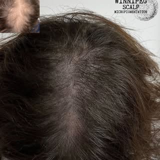 Winnipeg Scalp MicroPigmentation 
.
3 SMP sessions to complete density treatment to camouflage alope