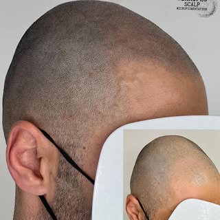 Winnipeg Scalp MicroPigmentation 
.
Added density to the front line , to create a fuller natural hai