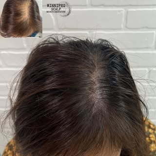 Winnipeg Scalp MicroPigmentation 
.
Density treatment done to help camouflage thinning. 
. 
(Photo t