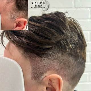 Winnipeg Scalp MicroPigmentation 
.
SMP treatment done to help camouflage alopecia spots along templ