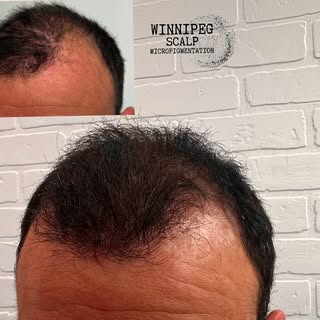 Winnipeg Scalp MicroPigmentation 
.
SMP treatment to help camouflage thinning and car accident scar.