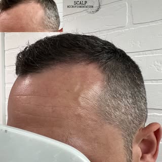 Winnipeg Scalp MicroPigmentation 
.
Density treatment to help camouflage thinning and even out hairl
