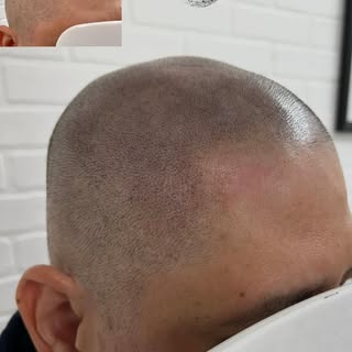 Winnipeg Scalp MicroPigmentation 
.
New hairline and density treatment for this client. 
.

Are you 