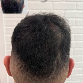 This client had a lot of thinning around his cowlick at the back of his head. After three SMP densit