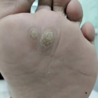 Say goodbye to warts and moles! Book your appointment now @ssaestheticwellnesscenter #cornwarts #war