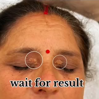 ✨ Say Goodbye to Xanthelasma! ✨

Aankhon ke aas-paas dikhne wale yellowish cholesterol deposits (Xan