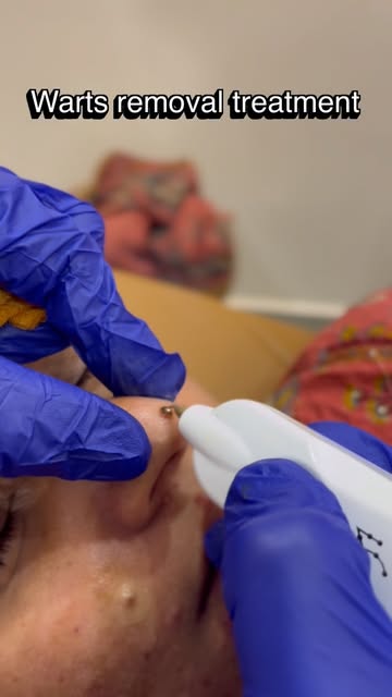 * Goodbye Warts, Hello Clear Skin!
Warts can be small, but they can affect your confidence. Our Wart