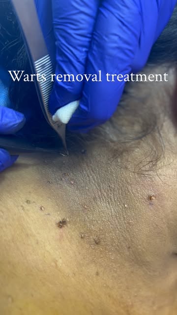 🩺 Warts Removal Treatment by Doctor
Unwanted warts? Get them assessed and treated by an experienced