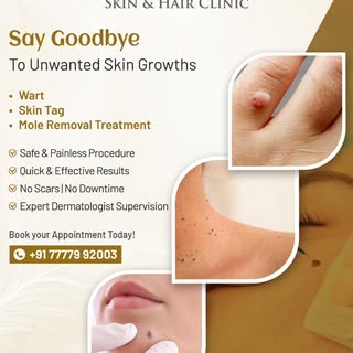 Say goodbye to unwanted skin growths and hello to flawless skin! 💫
Safe, painless & effective treat
