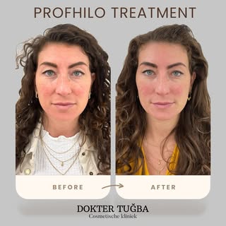 Wat is een Profhilo behandeling?

#Profhilo is ultrapuur hyaluronzuur zonder chemische toevoegingen 