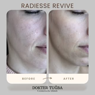 Wat is Radiesse Revive Hybrid?

Radiesse Revive Hybrid is een behandelingscombinatie waarbij #Radies