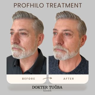 ✨ #Profhilo – 3 weken later ✨

Na drie weken zie je vaak al een mooie verbetering in stevigheid en h