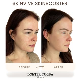 Nafoto is 1 maand na een Skinvive Skinbooster behandeling🩵

Wat zie je?
Verbeterde hydratatie💦
nat