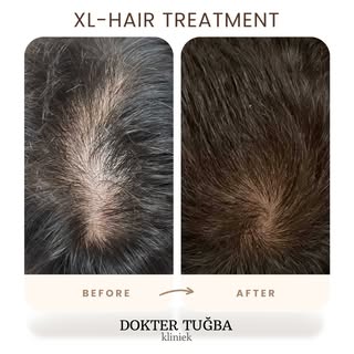 XL-Hair Treatment | Man
Before: mei 2025 • After: december 2025

XL-Hair is een hairbooster op basis