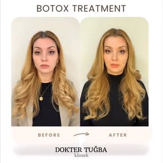 Botox resultaat na 2 weken🩶
Frons • Voorhoofd • Kraaienpootjes • Wenkbrauwlift • Gummy smile • Kin 
