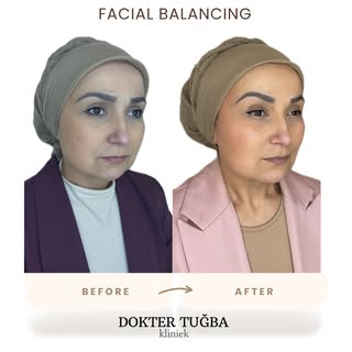 Before & After Facial Balancing ✨

Geen overmatige volume-opbouw. Geen verandering van identiteit.

