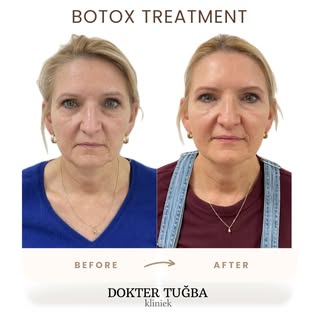 ✨ Before & After Botox ✨

Niet strak. Niet bevroren. Gewoon een frisse, uitgeruste versie van jezelf