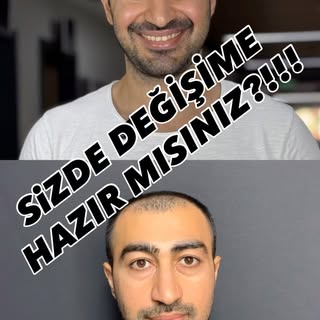 Tarzınızı Yansıtmaya Geliyoruz 😎
.
.
.
.
.
.
Saç ekimi, genellikle genetik dökülme (erkek tipi kell