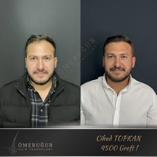 Cihad TOPKAN 4500 Greft Muhteşem Sonuç !

Doğallıkta sınır tanımadığımız doğrudur! 😎

☎️ 0533458289