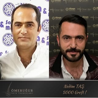 Gerçek başarının en güzel göstergesi zamana meydan okuyan sonuçlardır.

Yıllar önce 5000 greft saç e