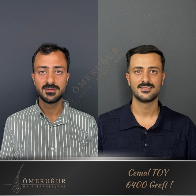Sıklık dikkat çeker, doğallık fark yaratır. 

Saç ekiminde hedef yalnızca daha fazla saç değil; yüz 