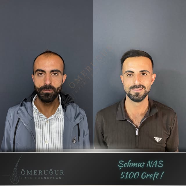 1 yıl önce başlayan değişim, bugün doğallığın en güçlü haliyle karşımızda. ✨

Saç yapısına ve yüz ha
