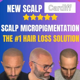 SMP @belletoujours1 
By Hayley @newscalpuk 
📍Cardiff

June Discount:
50% OFF Scalp MicroPigmentatio