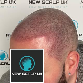 Scalp Micro Pigmentation by Hayley @newscalpuk 
Disguising Hairloss .... Restoring Hairlines & Confi