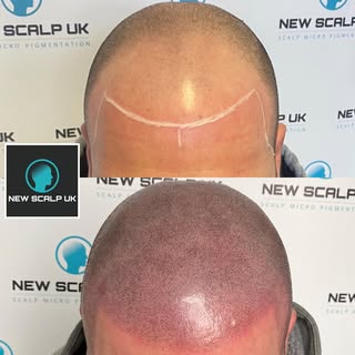 Scalp Micro Pigmentation by Hayley @newscalpuk 
Disguising Hairloss .... Restoring Hairlines & Confi