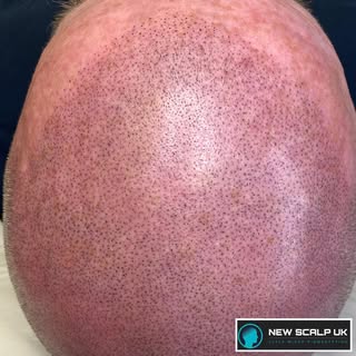 Session 2 SMP on Norwood Scale 7 Hairloss 

In just 3 x 2 hour sessions 

We can take you from bald 