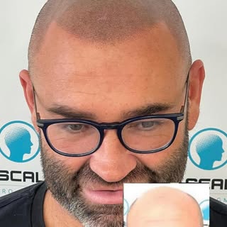 Restoring Hairlines with SMP 

Concealing the visible scalp skin where Hairloss is present 

Disguis